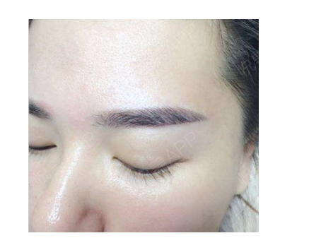 拉皮和提眉哪个效果好 提眉的疤痕多久可以恢复