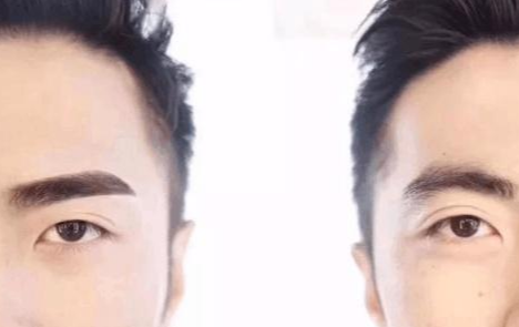 男士植眉毛前后对比照片 植眉毛需要多久时间
