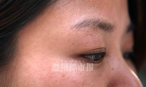 女子在化妆培训学校纹眼线 竟致双眼角膜上皮脱落