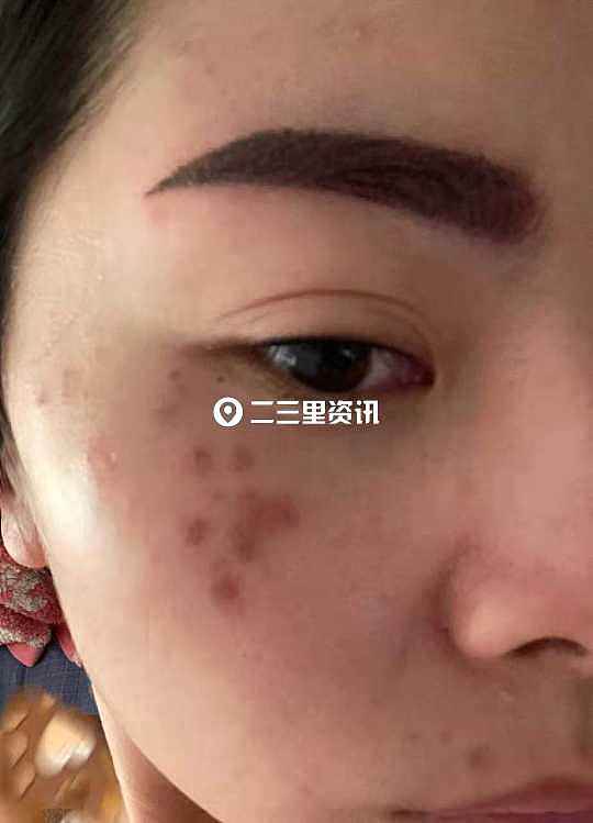 女子自称去雪儿纹绣美容院纹眉被强行做脸，医院检查诊断为刺激性皮炎