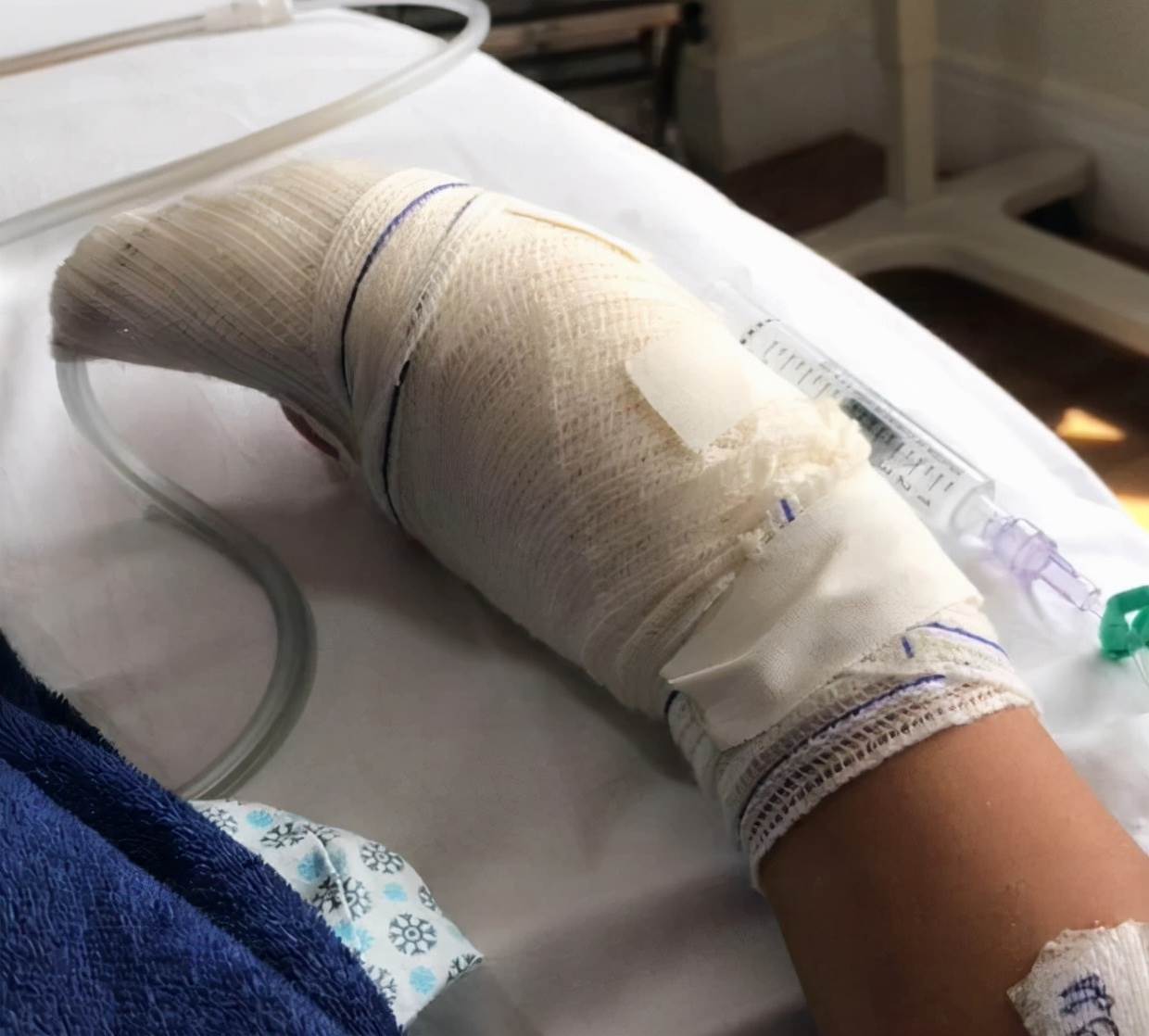 巴西妹子做美甲后拇指肿胀疼痛难忍，再去医院惨被截掉指尖