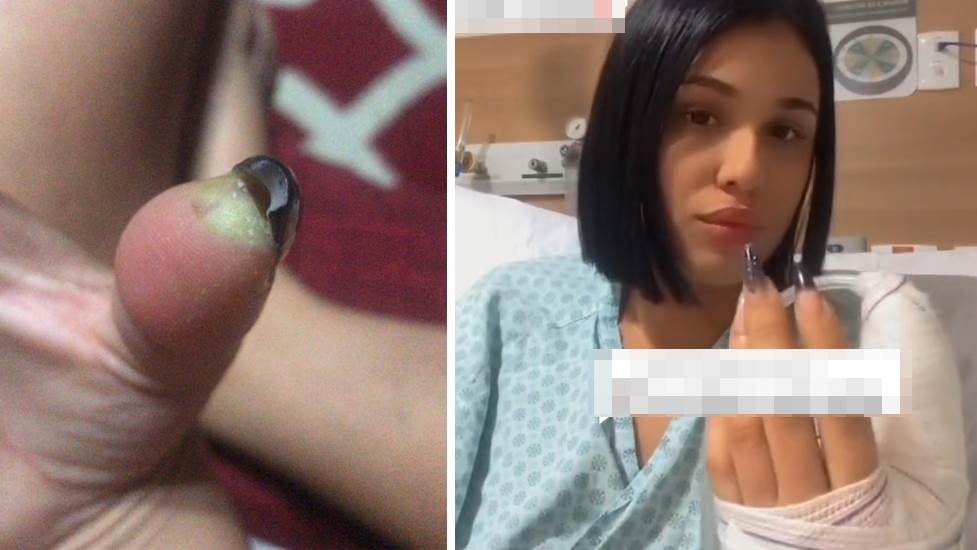 巴西女子美甲后导致拇指伤口感染 被迫截掉指尖