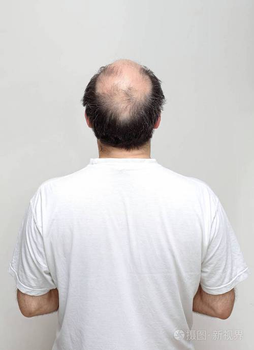 中年秃顶男人发型图片 中年秃顶男人发型图片大全