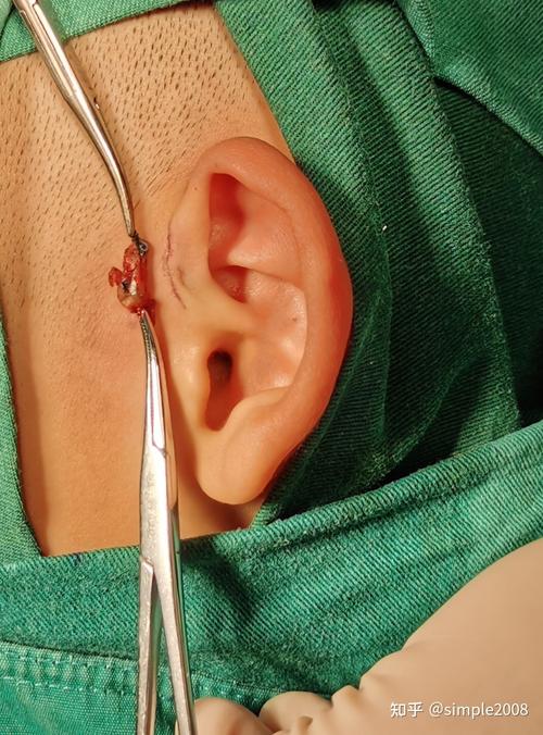 耳瘘管手术剃头发图片 耳瘘管手术切除做完后还会复发吗
